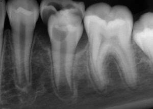 Dental radiograph with AI-detected findings